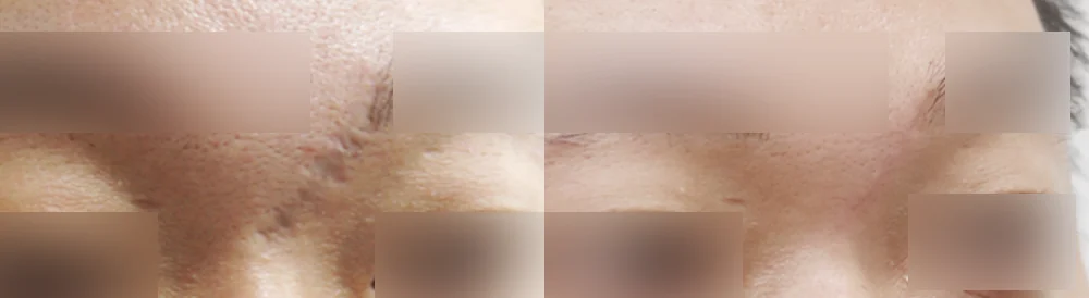 Face 패인·절개 흉터 시술 전후 사진 9 · 보니따의원
