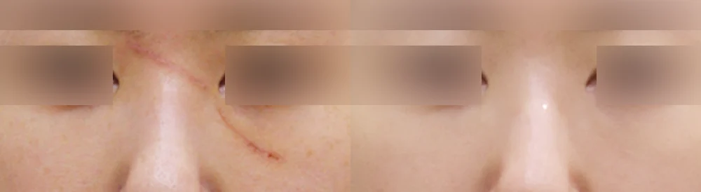 Face 패인·절개 흉터 시술 전후 사진 10 · 보니따의원