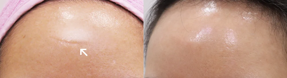 Face 패인·절개 흉터 시술 전후 사진 11 · 보니따의원