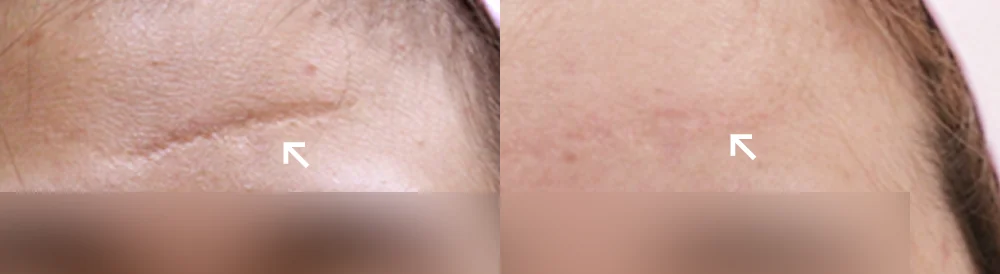 Face 패인·절개 흉터 시술 전후 사진 12 · 보니따의원