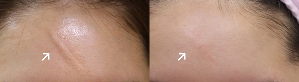 Face 패인·절개 흉터 시술 전후 사진 13 · 보니따의원