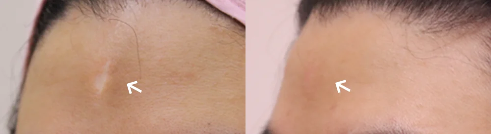 Face 패인·절개 흉터 시술 전후 사진 14 · 보니따의원