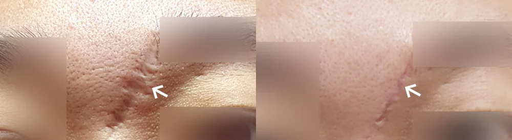 Face 패인·절개 흉터 시술 전후 사진 15 · 보니따의원