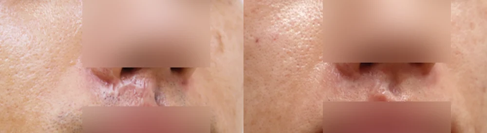 Face 패인·절개 흉터 시술 전후 사진 17 · 보니따의원