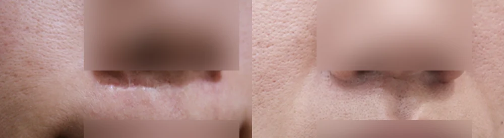 Face 패인·절개 흉터 시술 전후 사진 18 · 보니따의원