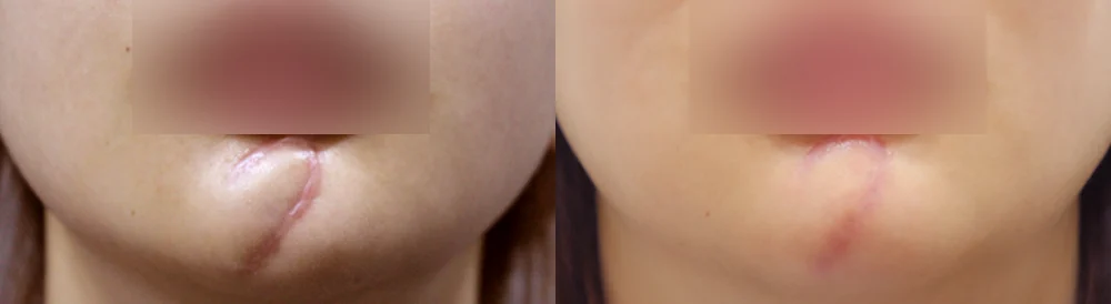 Face 패인·절개 흉터 시술 전후 사진 19 · 보니따의원