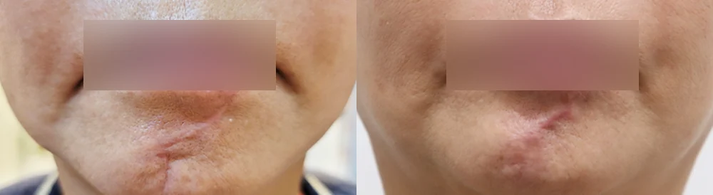 Face 패인·절개 흉터 시술 전후 사진 20 · 보니따의원