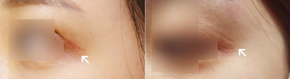 Face 패인·절개 흉터 시술 전후 사진 3 · 보니따의원