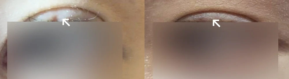 臉部整形疤痕 術前術後照片 4 · Bonita醫院