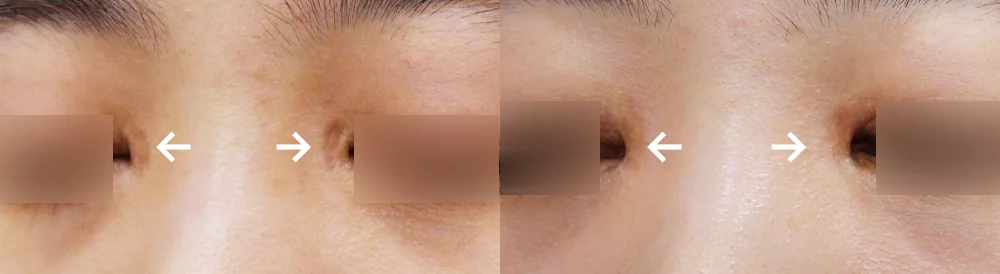 臉部整形疤痕 術前術後照片 1 · Bonita醫院