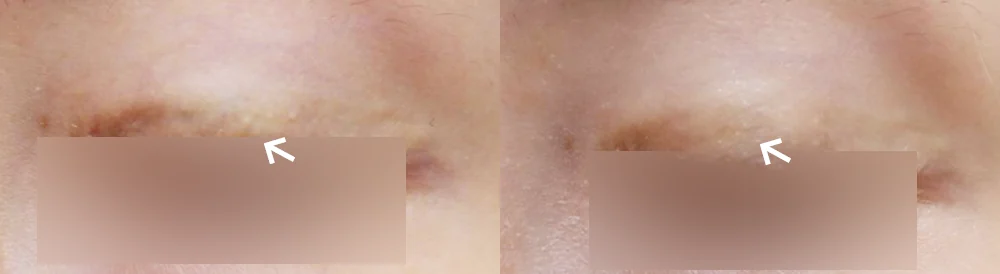臉部整形疤痕 術前術後照片 2 · Bonita醫院