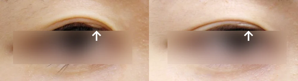 臉部整形疤痕 術前術後照片 6 · Bonita醫院