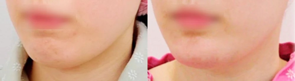 돌출입 지방이식 시술 전후 사진 1 · 보니따의원