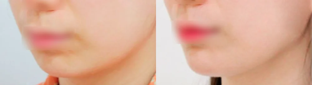 돌출입 지방이식 시술 전후 사진 2 · 보니따의원