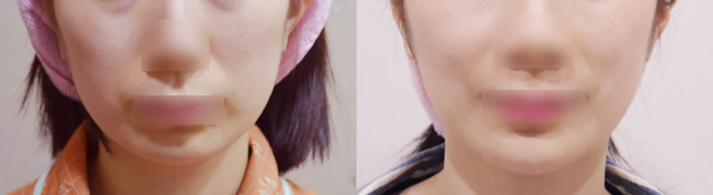 돌출입 지방이식 시술 전후 사진 5 · 보니따의원