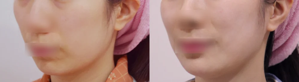 돌출입 지방이식 시술 전후 사진 7 · 보니따의원