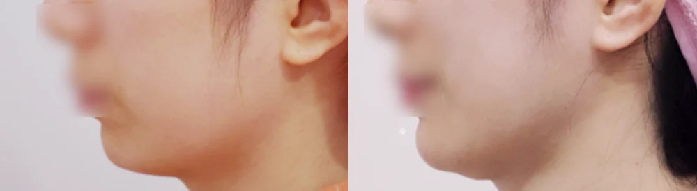 돌출입 지방이식 시술 전후 사진 8 · 보니따의원