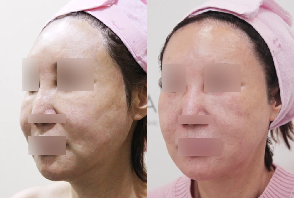 이마·턱·볼 성형 부작용 재건 시술 전후 사진 1 · 보니따의원