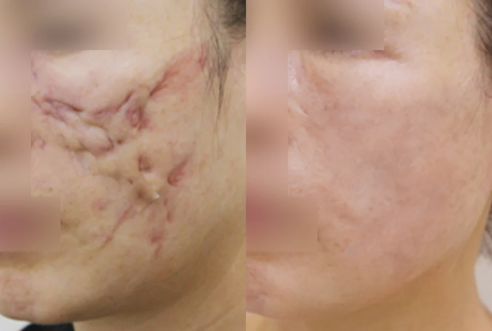 이마·턱·볼 성형 부작용 재건 시술 전후 사진 2 · 보니따의원
