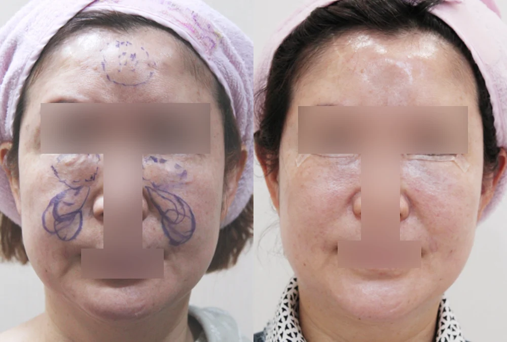 이마·턱·볼 성형 부작용 재건 시술 전후 사진 3 · 보니따의원