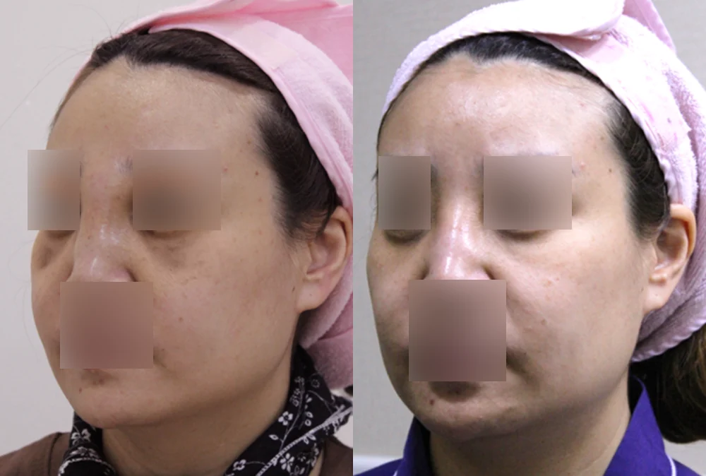 이마·턱·볼 성형 부작용 재건 시술 전후 사진 5 · 보니따의원