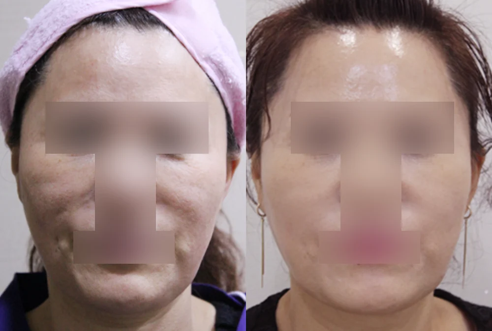 이마·턱·볼 성형 부작용 재건 시술 전후 사진 7 · 보니따의원