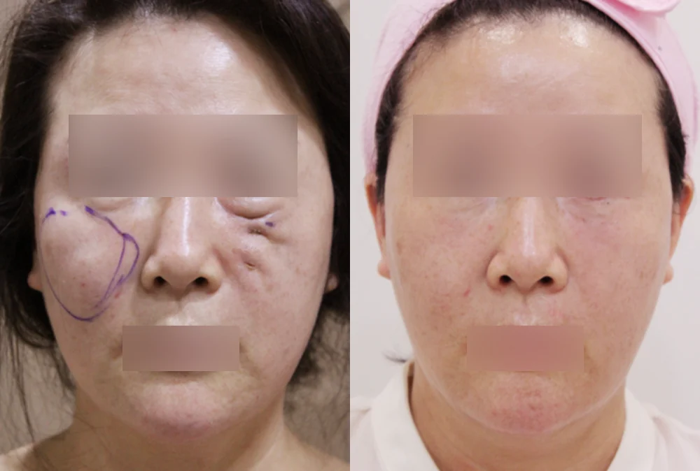 이마·턱·볼 성형 부작용 재건 시술 전후 사진 9 · 보니따의원