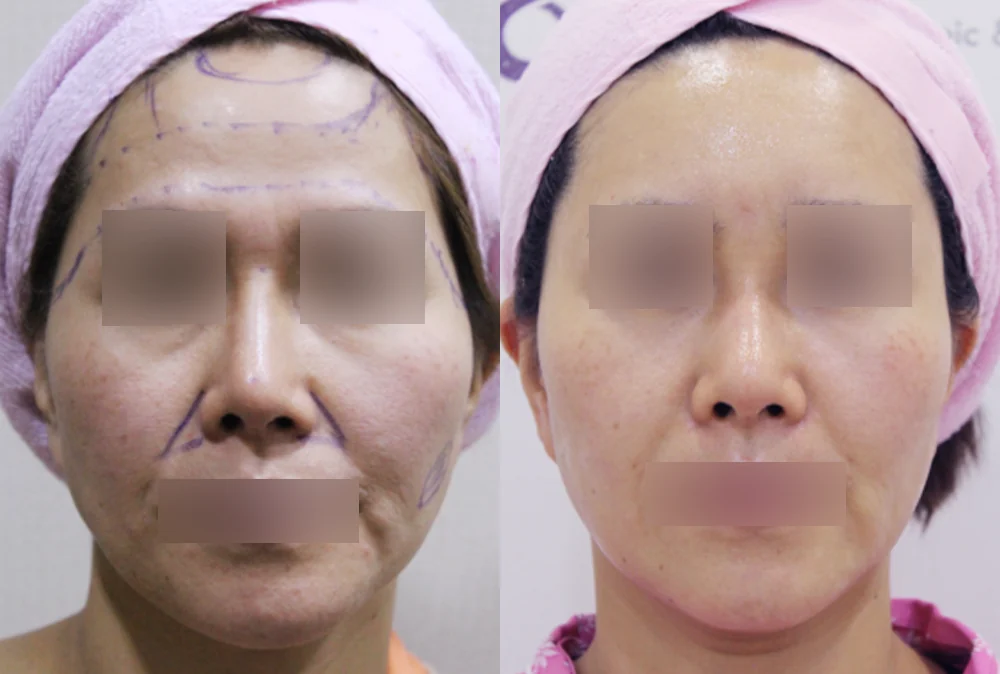 이마·턱·볼 성형 부작용 재건 시술 전후 사진 10 · 보니따의원