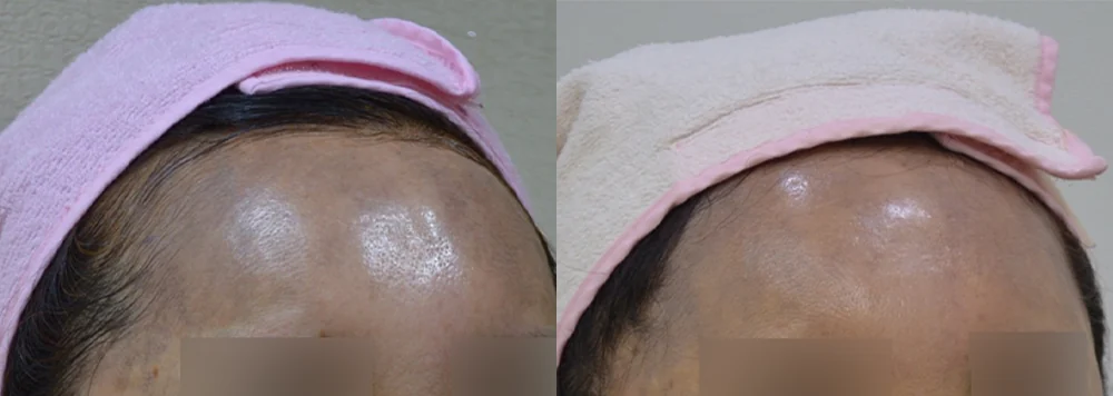 이마·턱·볼 성형 부작용 재건 시술 전후 사진 12 · 보니따의원