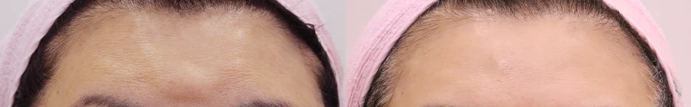 이마·턱·볼 성형 부작용 재건 시술 전후 사진 13 · 보니따의원