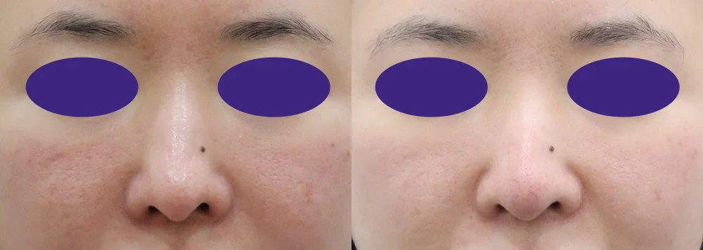 코 성형 시술 전후 사진 11 · 보니따의원