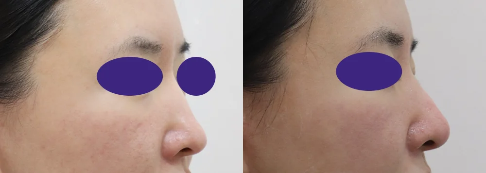 전체 코 수술 시술 전후 사진 9 · 보니따의원