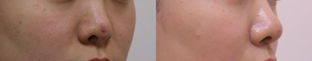 전체 코 수술 시술 전후 사진 18 · 보니따의원