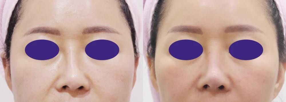 보형물 재수술 시술 전후 사진 8 · 보니따의원