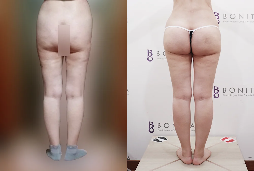 지방흡입 재수술 시술 전후 사진 9 · 보니따의원