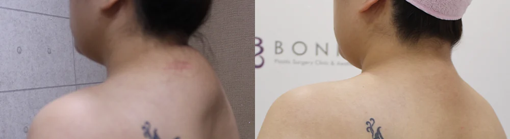 Body Contouring Center before & after photo 15 · Bonita Clinic Seoul