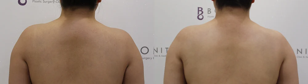 Body Contouring Center before & after photo 17 · Bonita Clinic Seoul