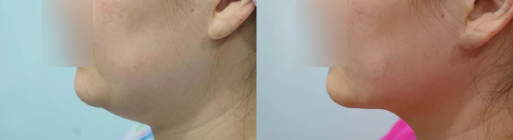ワンデー脂肪吸引 術前術後の写真 11 · ボニータクリニック