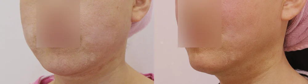 ワンデー脂肪吸引 術前術後の写真 12 · ボニータクリニック