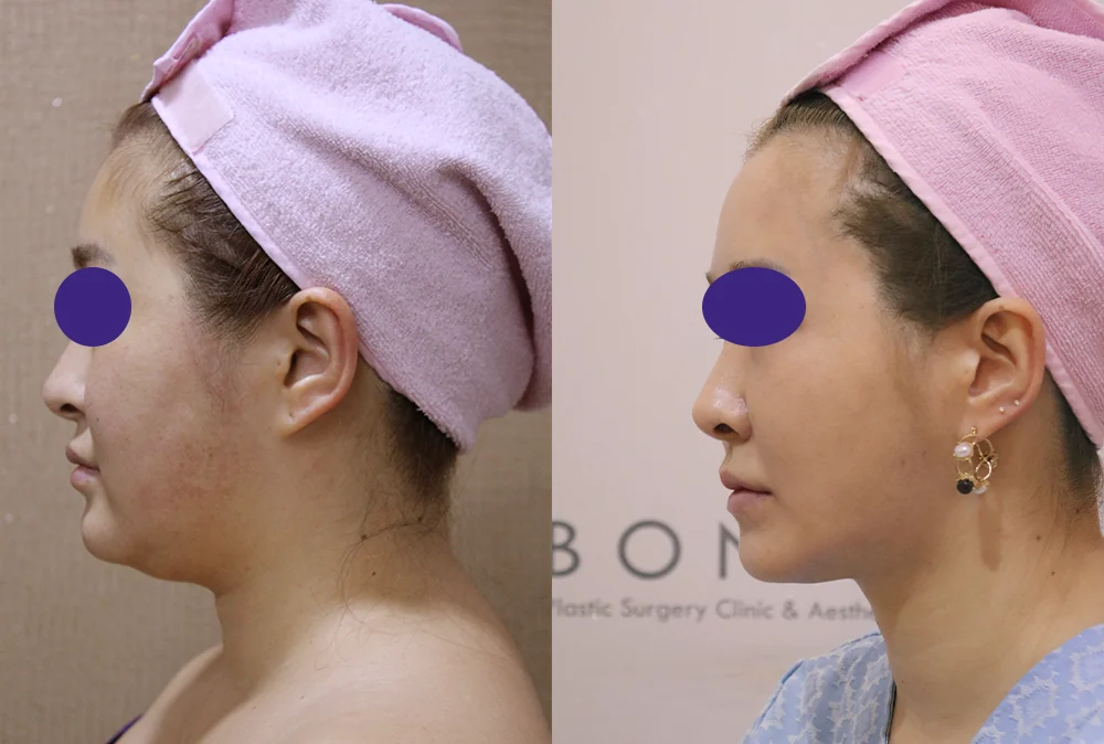 吸脂 术前术后照片 11 · Bonita医院