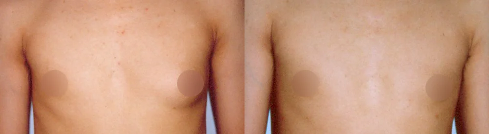 ワンデー脂肪吸引 術前術後の写真 14 · ボニータクリニック