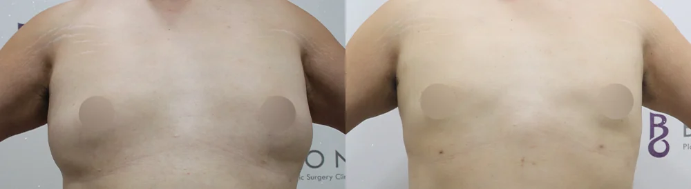 ワンデー脂肪吸引 術前術後の写真 15 · ボニータクリニック