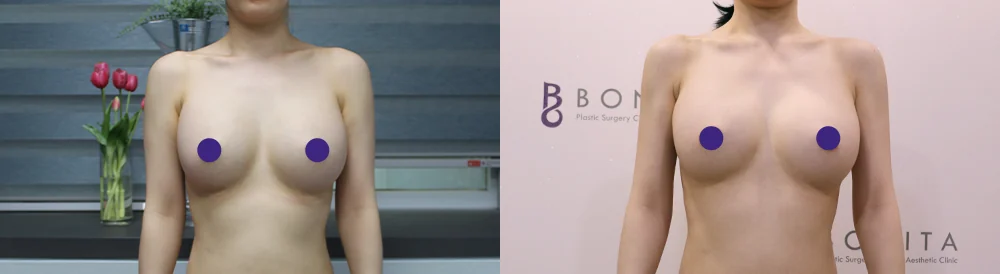 吸脂 术前术后照片 37 · Bonita医院