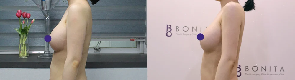吸脂 术前术后照片 38 · Bonita医院