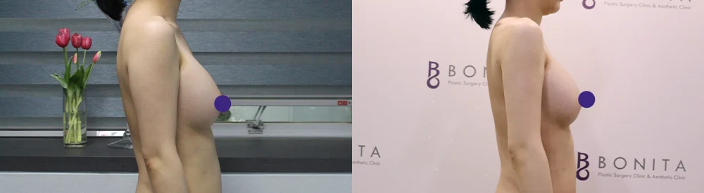 吸脂 术前术后照片 40 · Bonita医院