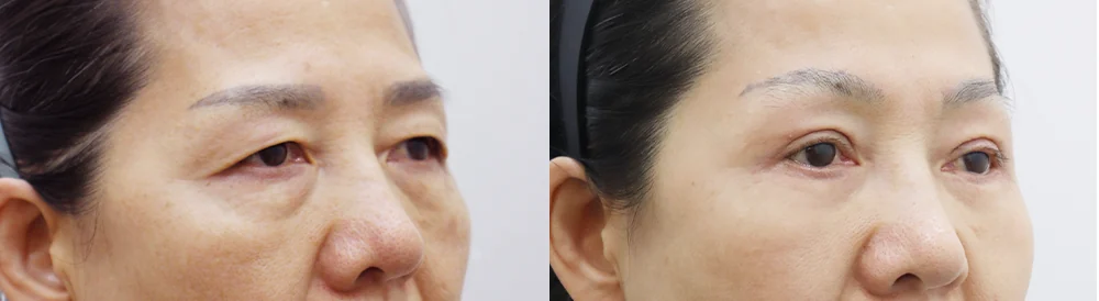 눈밑지방재배치 시술 전후 사진 5 · 보니따의원