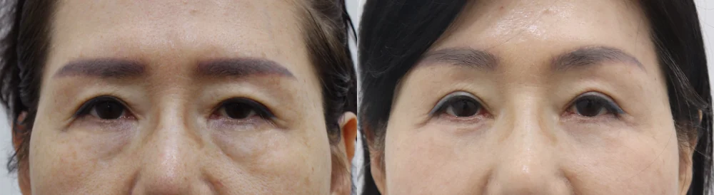 눈밑지방재배치 시술 전후 사진 7 · 보니따의원