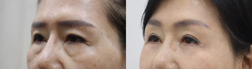 눈밑지방재배치 시술 전후 사진 8 · 보니따의원