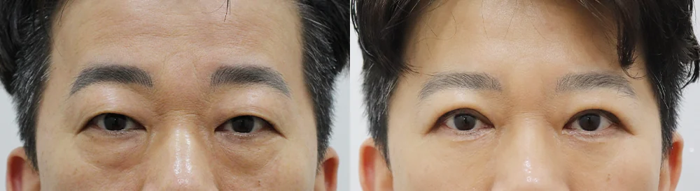 눈밑지방재배치 시술 전후 사진 10 · 보니따의원