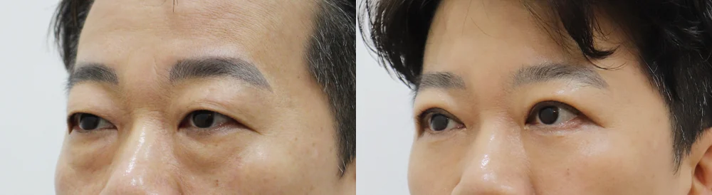 눈밑지방재배치 시술 전후 사진 11 · 보니따의원